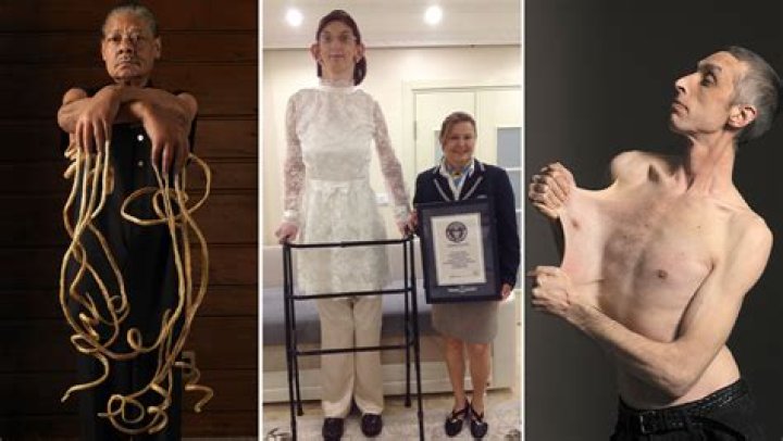 The Shocking Weight Of The World's Skinniest Person: A Medical Marvel